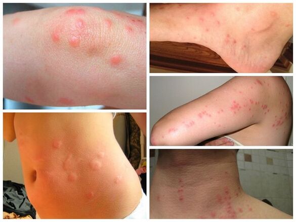 parasites de la peau