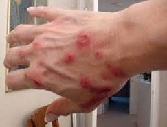Papules sur la peau avec l'elminiase